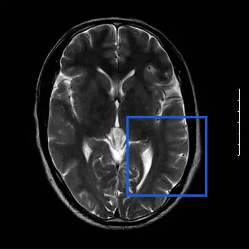 Head MRI with a marked lesion