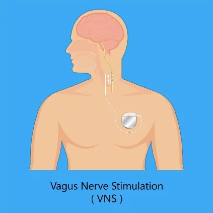 Schematic illustration of vagus nerve stimulation (VNS): pulse generator in the chest area with a lead to the vagus nerve in the neck